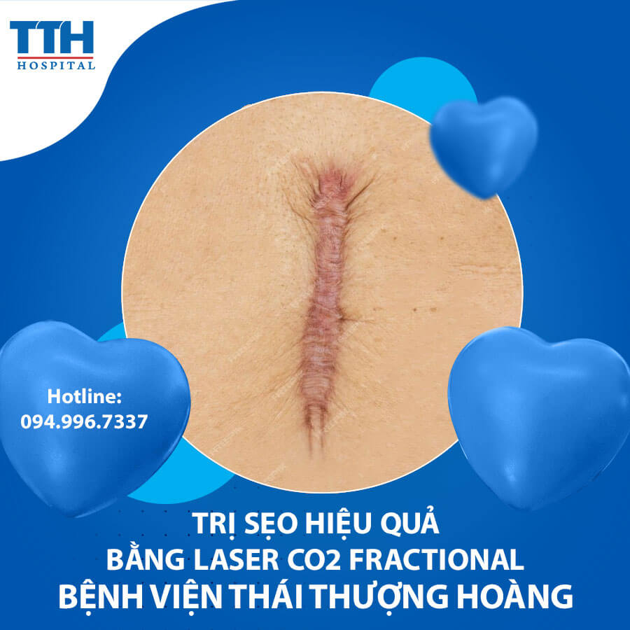 Trị sẹo hiệu quả bằng Laser CO2 Fractional