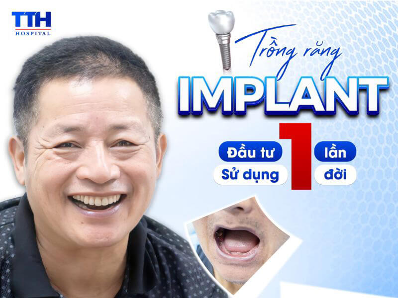 Trồng răng Implant Alphadent để ăn ngon hơn, sống vui khỏe hơn