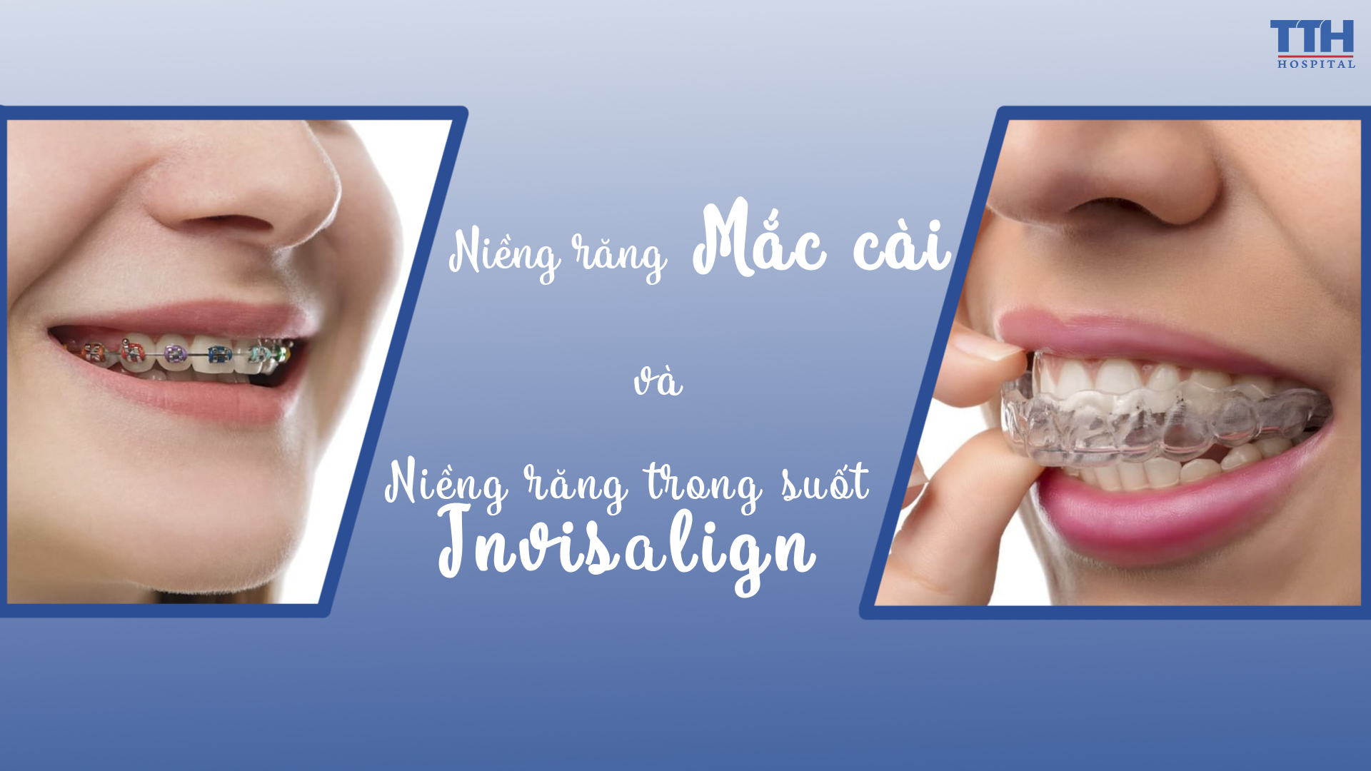 NIỀNG RĂNG MẮC CÀI VÀ NIỀNG RĂNG TRONG SUỐT INVISALIGN