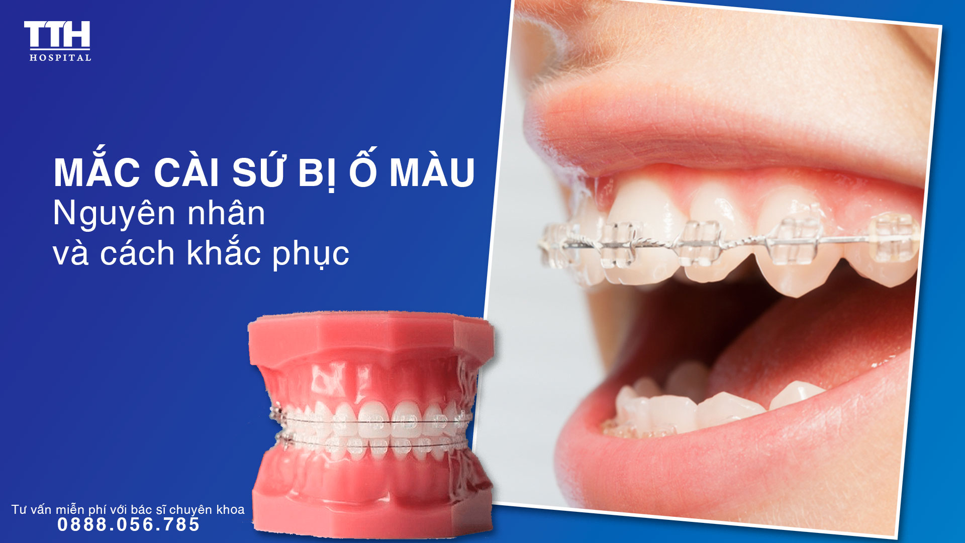 Mắc cài sứ bị ố màu - Nguyên nhân và cách khắc phục