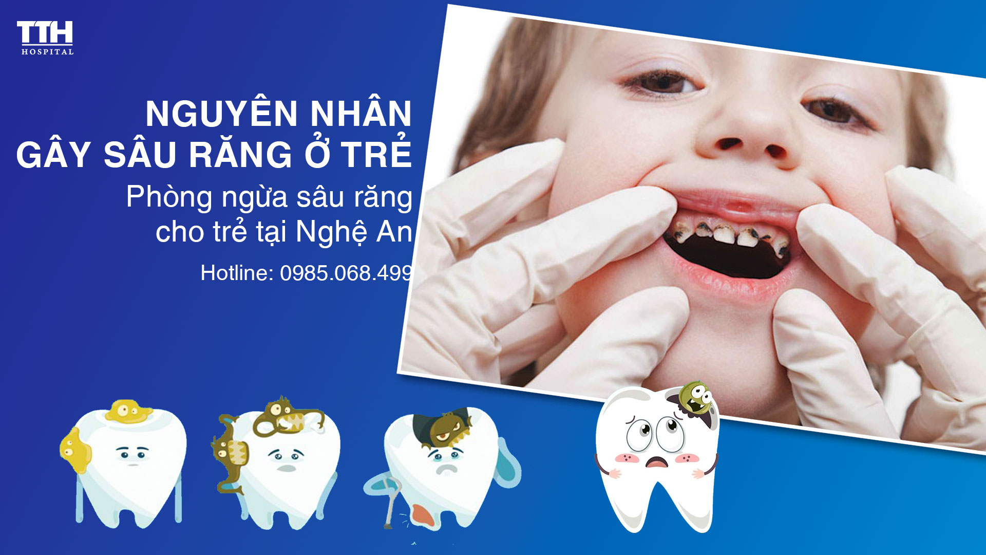 Nguyên nhân gây sâu răng ở trẻ. Phòng ngừa sâu răng cho trẻ tại Nghệ An